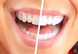 Отбеливание зубов: на сколько безопасна процедура?